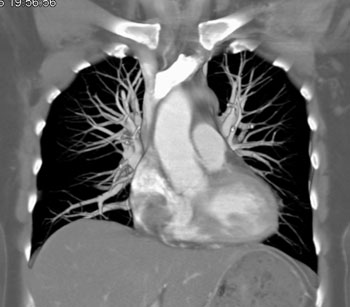 cardiac 64 mdct