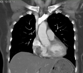 cardiac 64 mdct