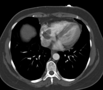 cardiac 64 mdct