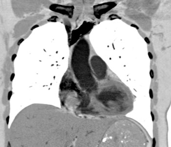 cardiac 64 mdct