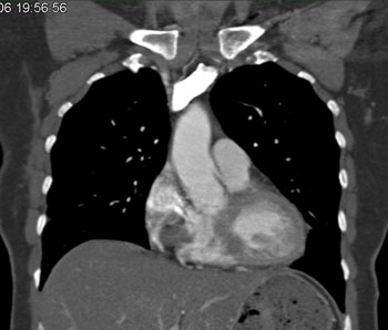 cardiac 64 mdct