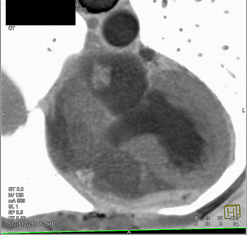 cardiac 64 mdct