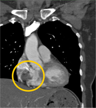 cardiac 64 mdct