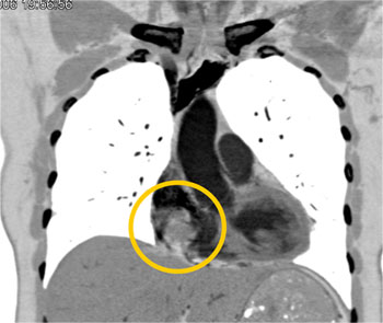 cardiac 64 mdct