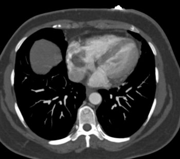 cardiac 64 mdct