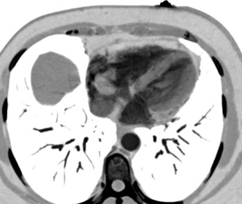 cardiac 64 mdct