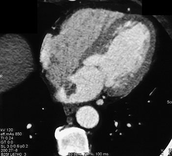 cardiac 64 mdct