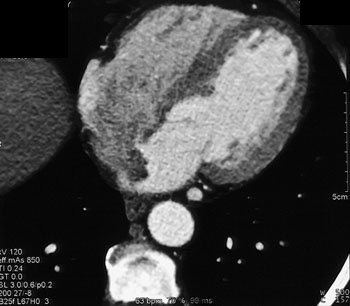 cardiac 64 mdct