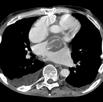 cardiac 64 mdct