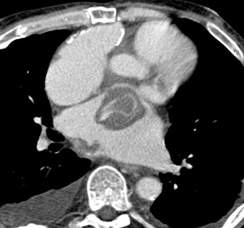 cardiac 64 mdct