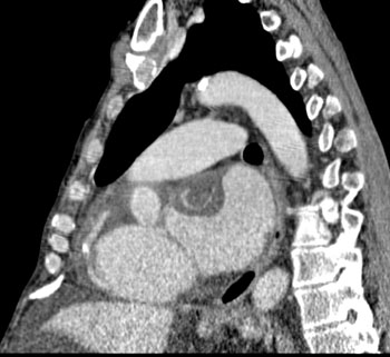 cardiac 64 mdct