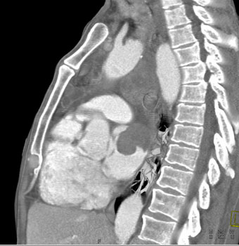 cardiac 64 mdct