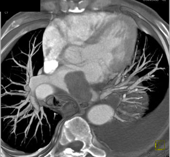 cardiac 64 mdct