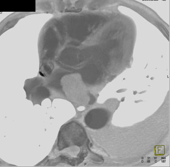 cardiac 64 mdct