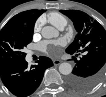 cardiac 64 mdct