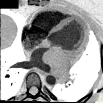 cardiac 64 mdct