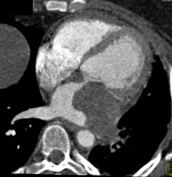 cardiac 64 mdct