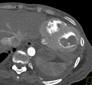 cardiac 64 mdct