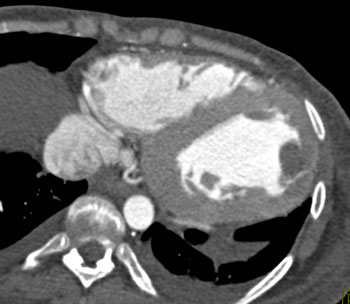 cardiac 64 mdct