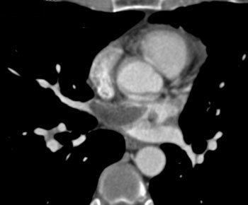 cardiac 64 mdct