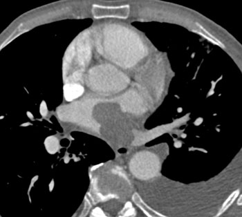 cardiac 64 mdct