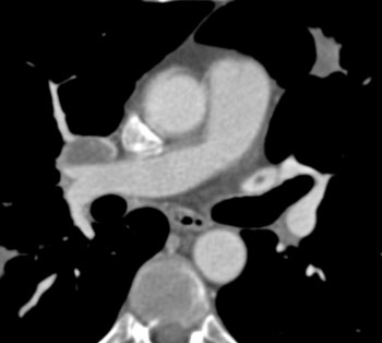 cardiac 64 mdct