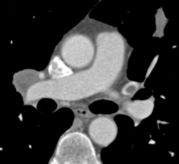 cardiac 64 mdct