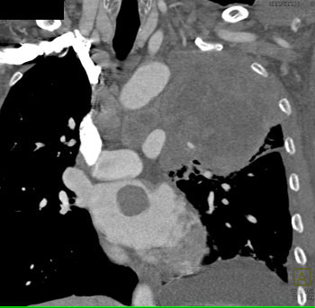 cardiac 64 mdct