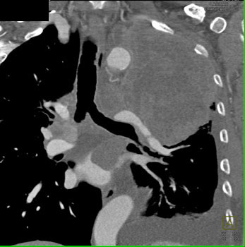 cardiac 64 mdct