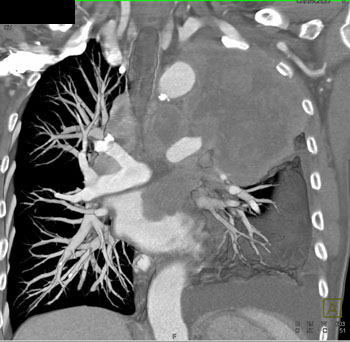 cardiac 64 mdct