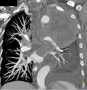 cardiac 64 mdct