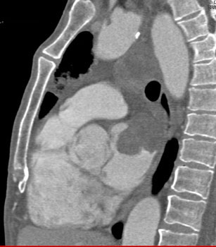 cardiac 64 mdct