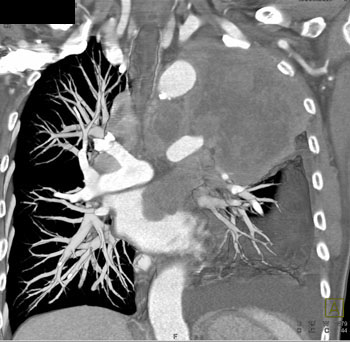 cardiac 64 mdct