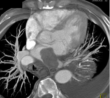 cardiac 64 mdct