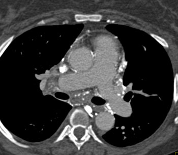 cardiac 64 mdct