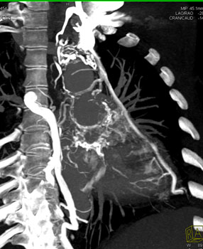 cardiac 64 mdct