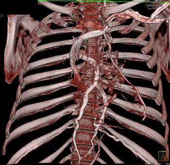 cardiac 64 mdct