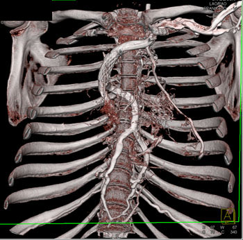 cardiac 64 mdct