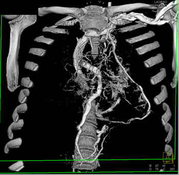 cardiac 64 mdct