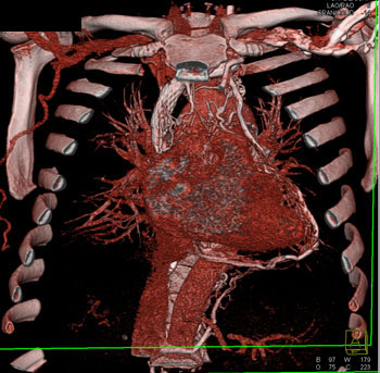 cardiac 64 mdct