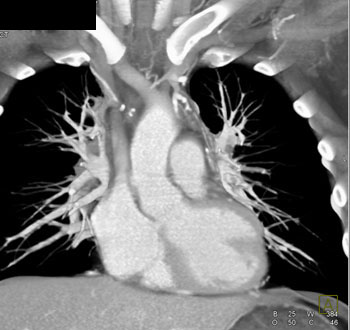 cardiac 64 mdct