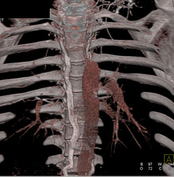 cardiac 64 mdct