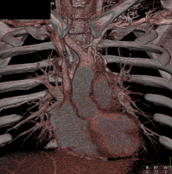 cardiac 64 mdct