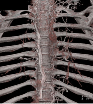 cardiac 64 mdct