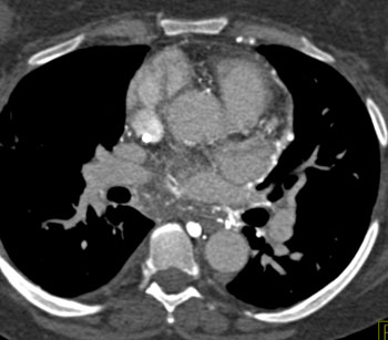 cardiac 64 mdct