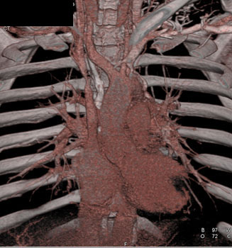 cardiac 64 mdct