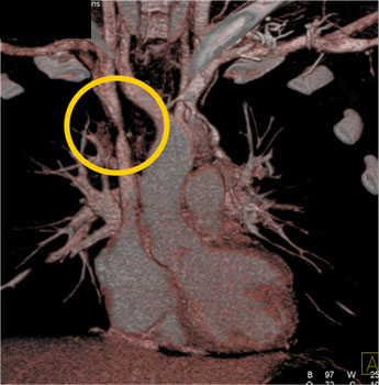 cardiac 64 mdct