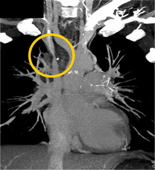 cardiac 64 mdct