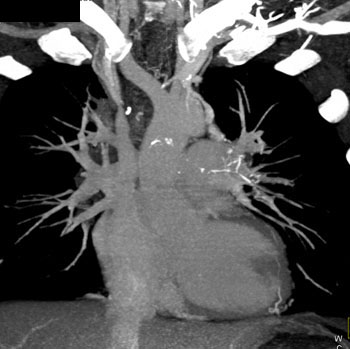 cardiac 64 mdct