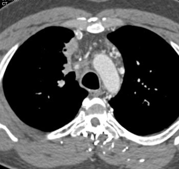 cardiac 64 mdct